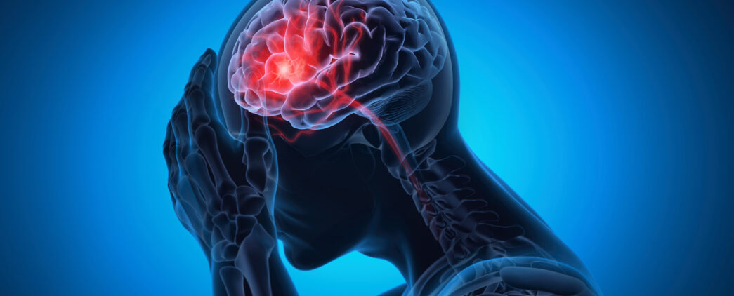 A 3D Illustration of a person holding their head signifying a brain stroke or headache.